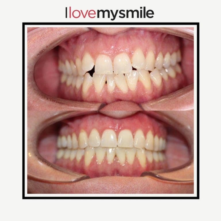 Zähne vor (schief) und nach (gerade) der Behandlung