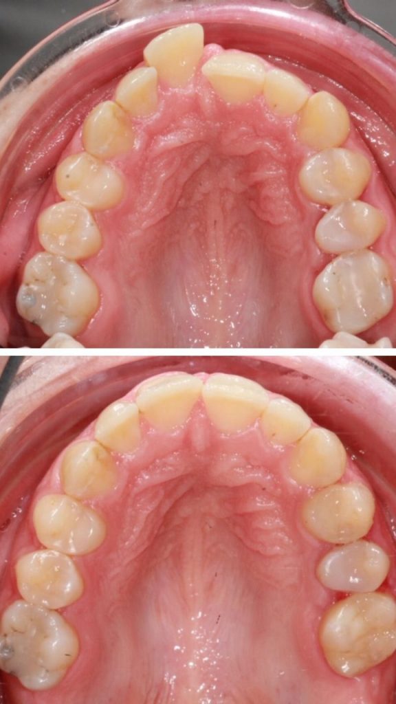 Beispiel für eine Zahnkorrektur mit Invisalign