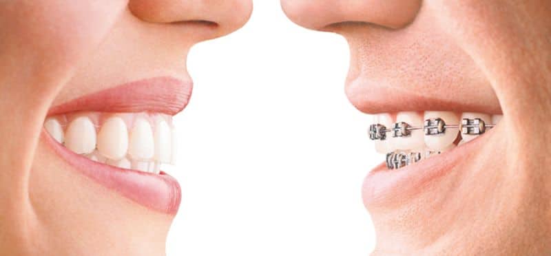 Invisalign und feste Spange- Zahnbegradigung bei Erwachsenen,Zahnspange